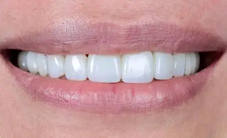 Smile after treatment - Case 1
