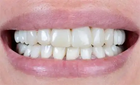 Smile before treatment - Case 1