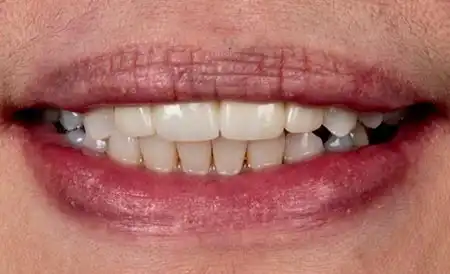 Smile after treatment - Case 2