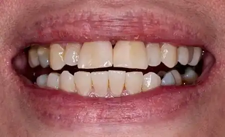 Smile before treatment - Case 2
