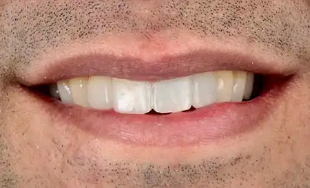 Smile after treatment - Case 3