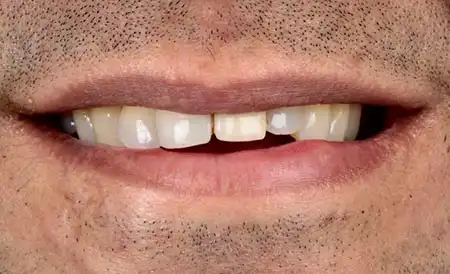 Smile before treatment - Case 3