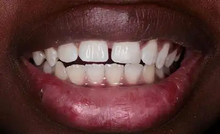 Smile after treatment - Case 4