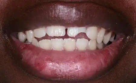 Smile before treatment - Case 4