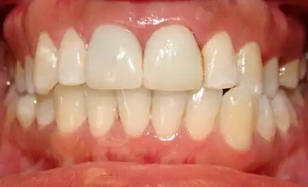 Smile after treatment - Case 5