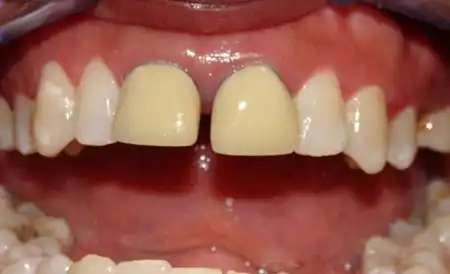 Smile before treatment - Case 5