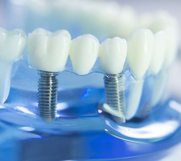 Missouri City Dental Implants