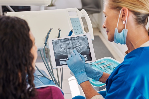 What You Should Know About The Failure Rate Of Root Canals